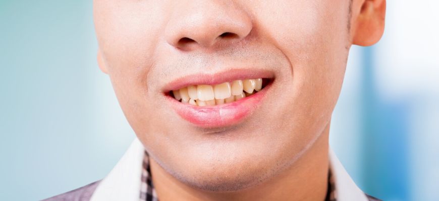 Common Yellow Teeth Causes and How to Prevent Discoloration