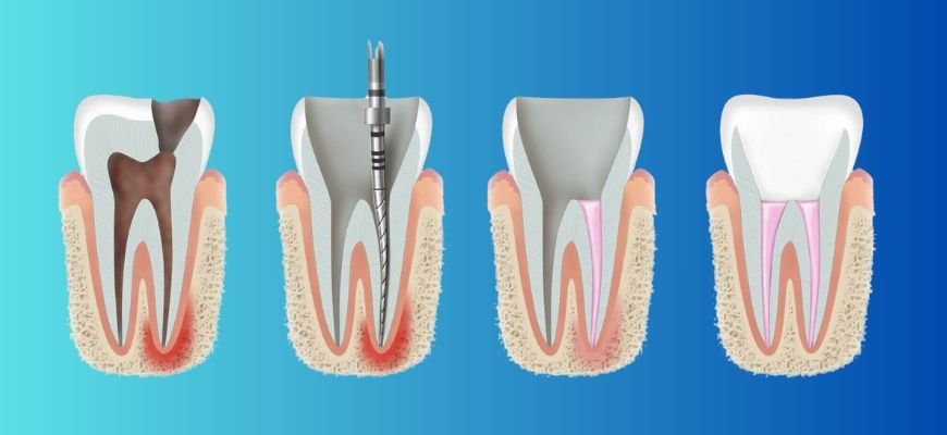Expert Guide to Root Canal Procedure in Hubli