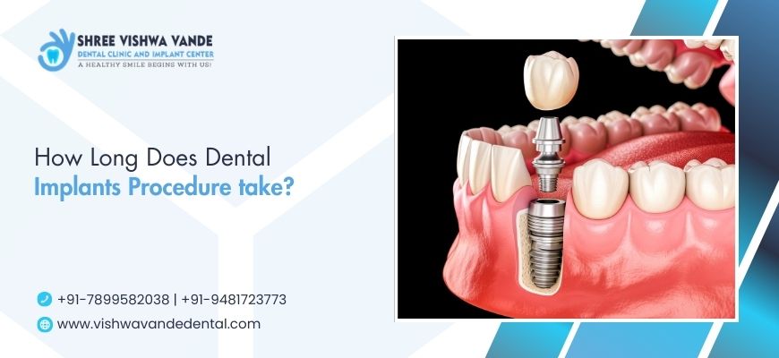 how long does dental implants procedure take?