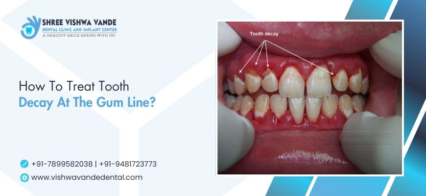 how to treat tooth decay at the gum line