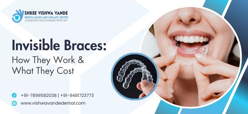 Invisible Braces: How They Work & What They Cost