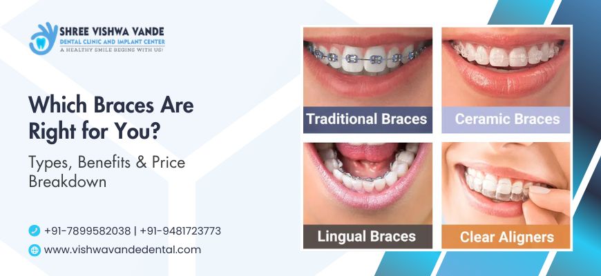 Which Braces Are Right for You? Types, Benefits & Price Breakdown